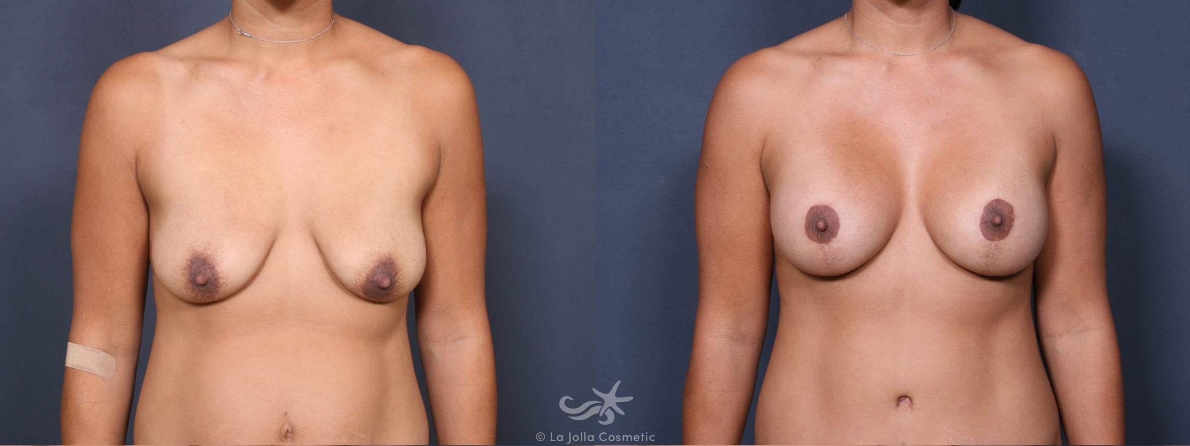 Before & After Breast Augmentation with Lift Result 317 Front View in San Diego, CA