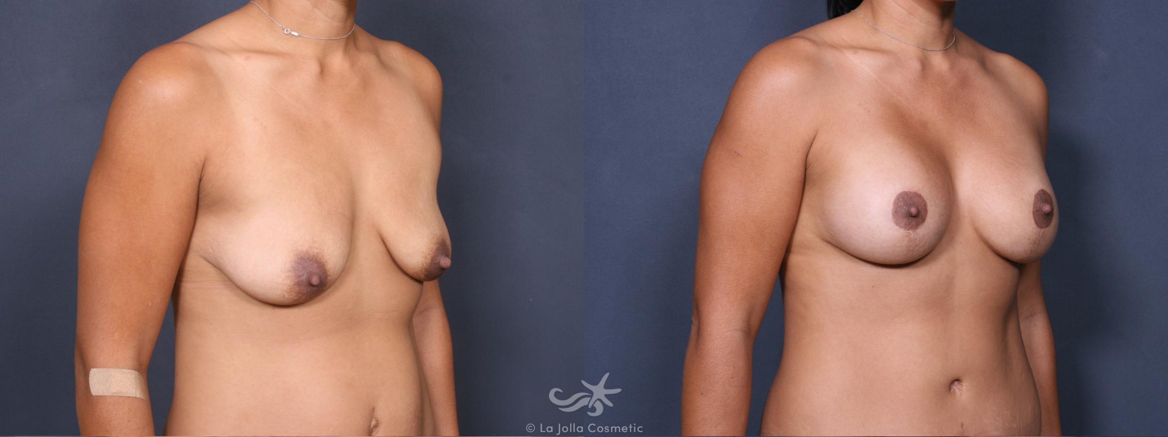 Before & After Breast Augmentation with Lift Result 317 Right Oblique View in San Diego, CA