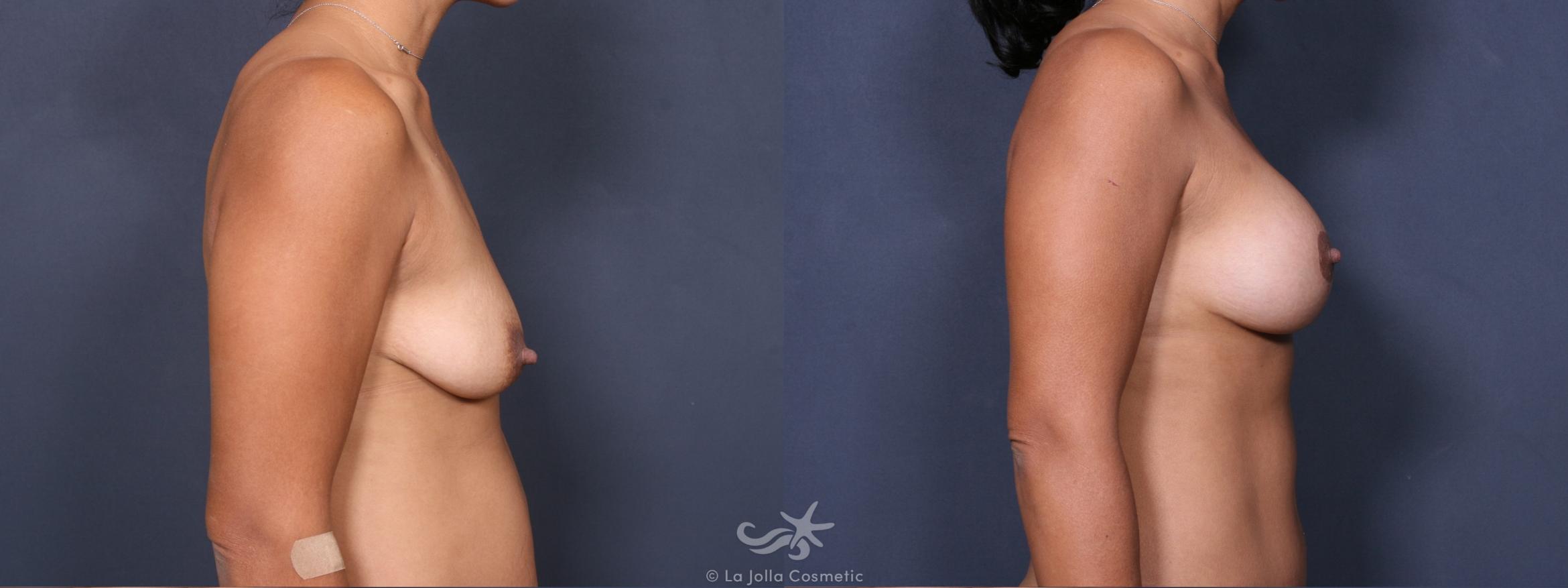 Before & After Breast Augmentation with Lift Result 317 Right Side View in San Diego, CA