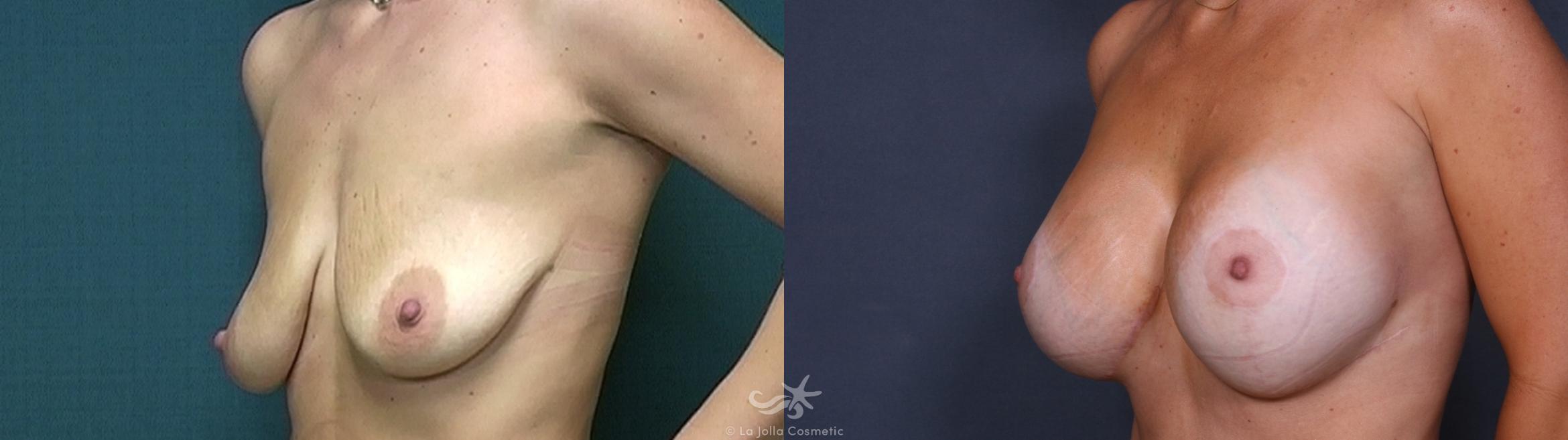 Before & After Breast Augmentation with Lift Result 329 Right Oblique View in San Diego, CA