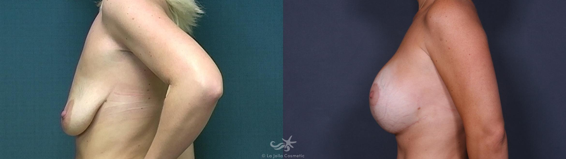 Before & After Breast Augmentation with Lift Result 329 Right Side View in San Diego, CA