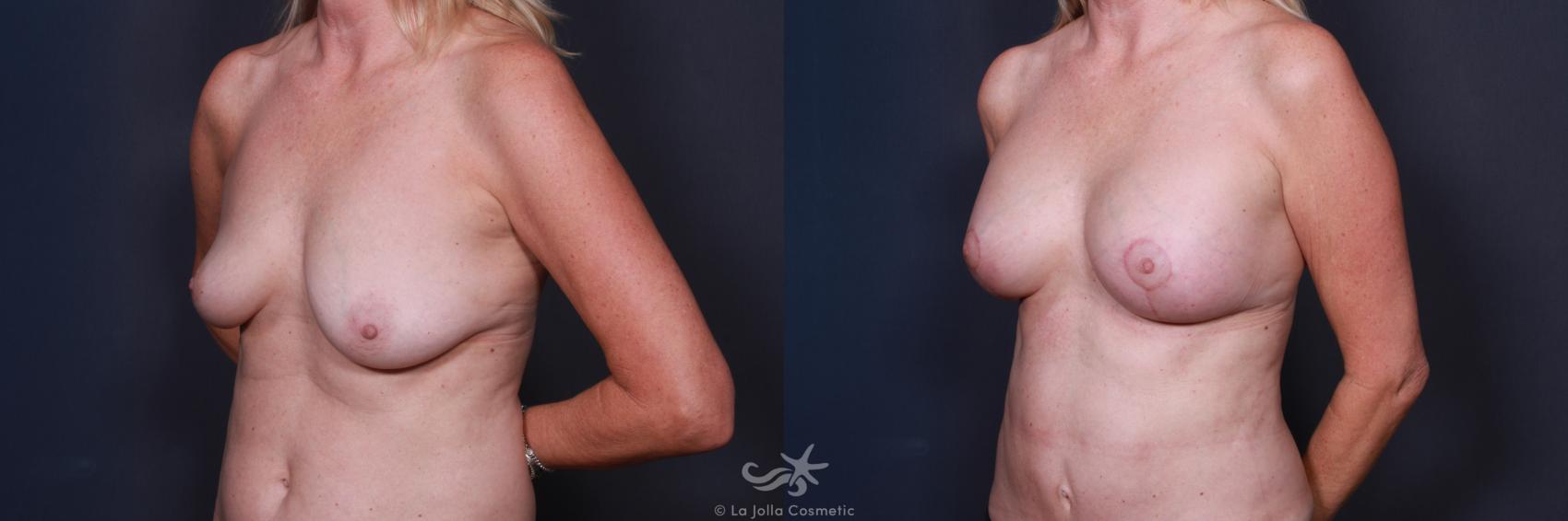 Before & After Breast Augmentation with Lift Result 36 Left Oblique View in San Diego, CA