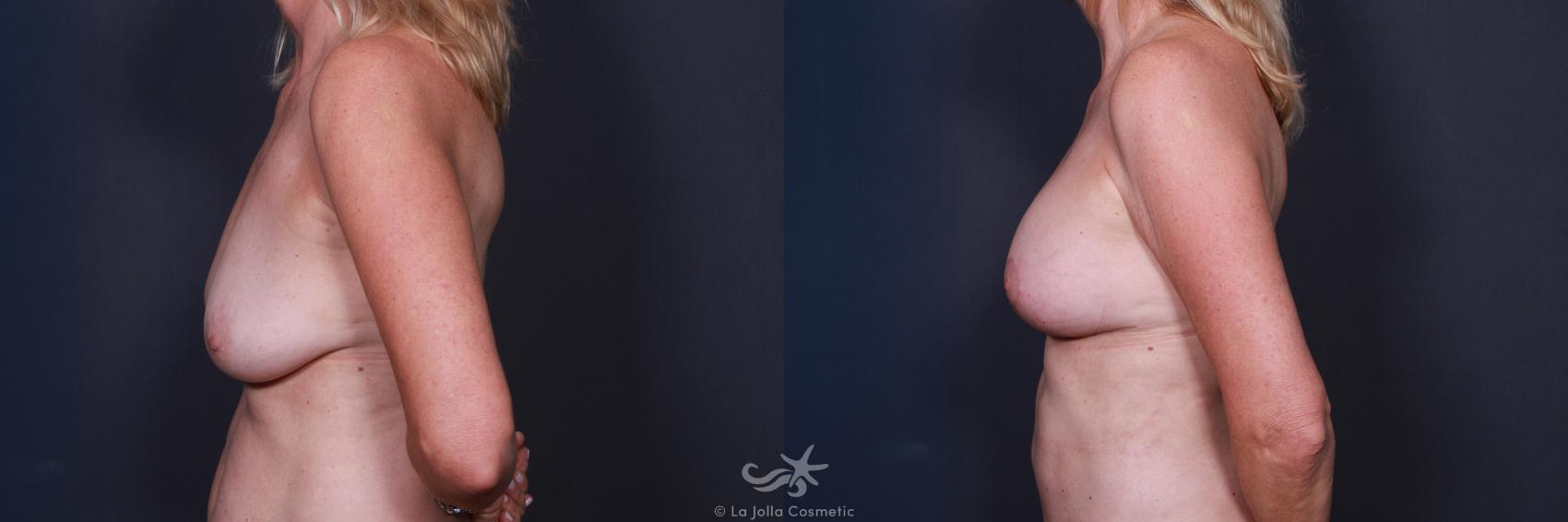 Before & After Breast Augmentation with Lift Result 36 Left Side View in San Diego, CA