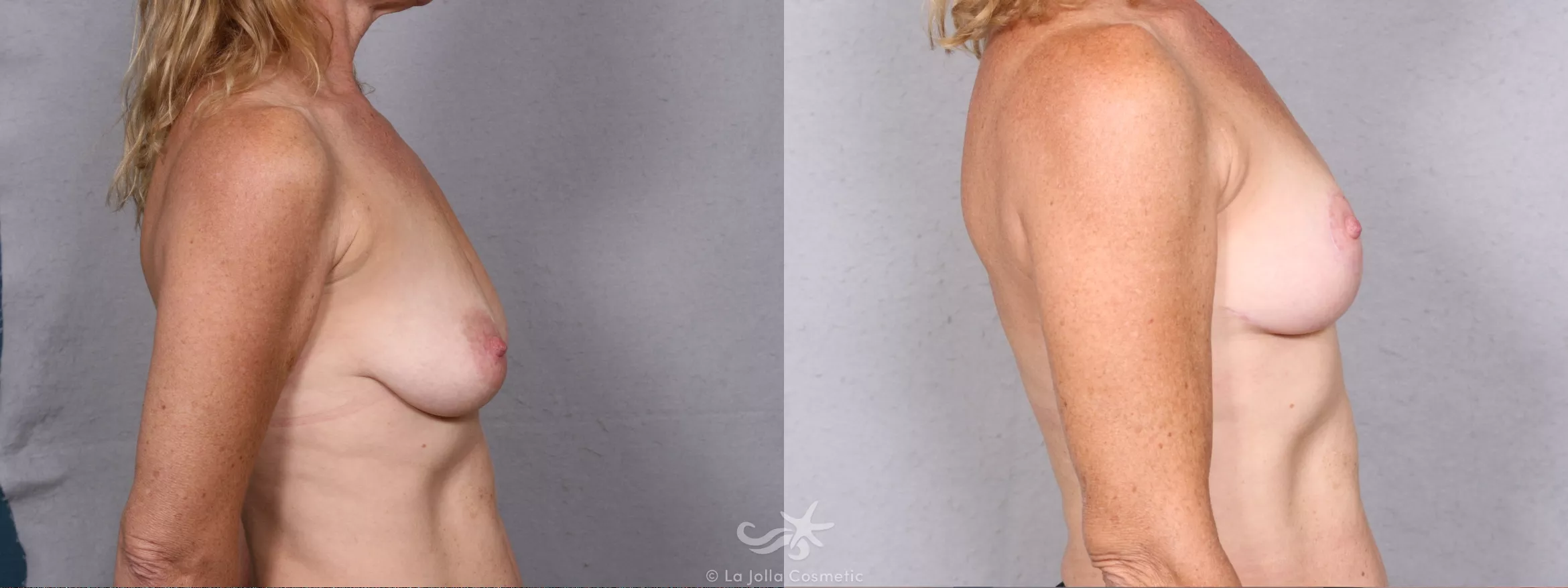 Before & After Breast Augmentation with Lift Result 368 Right Side View in San Diego, CA