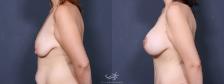 Before & After Breast Augmentation with Lift Result 373 Left Side View in San Diego, Carlsbad, CA