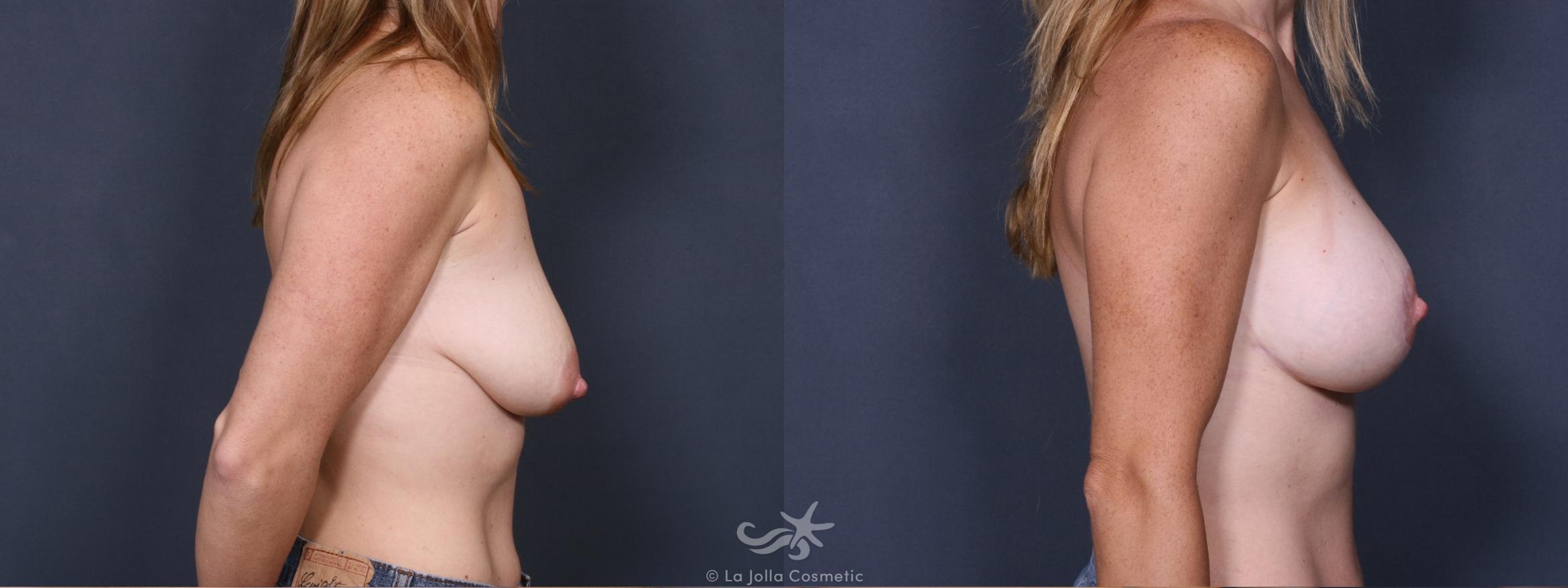 Before & After Breast Augmentation with Lift Result 378 Right Side View in San Diego, CA