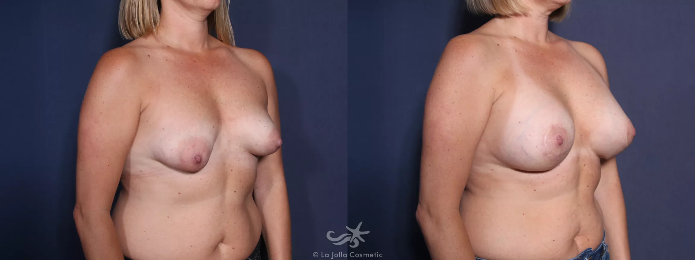 Before & After Breast Augmentation with Lift Result 39 Right Oblique View in San Diego, CA