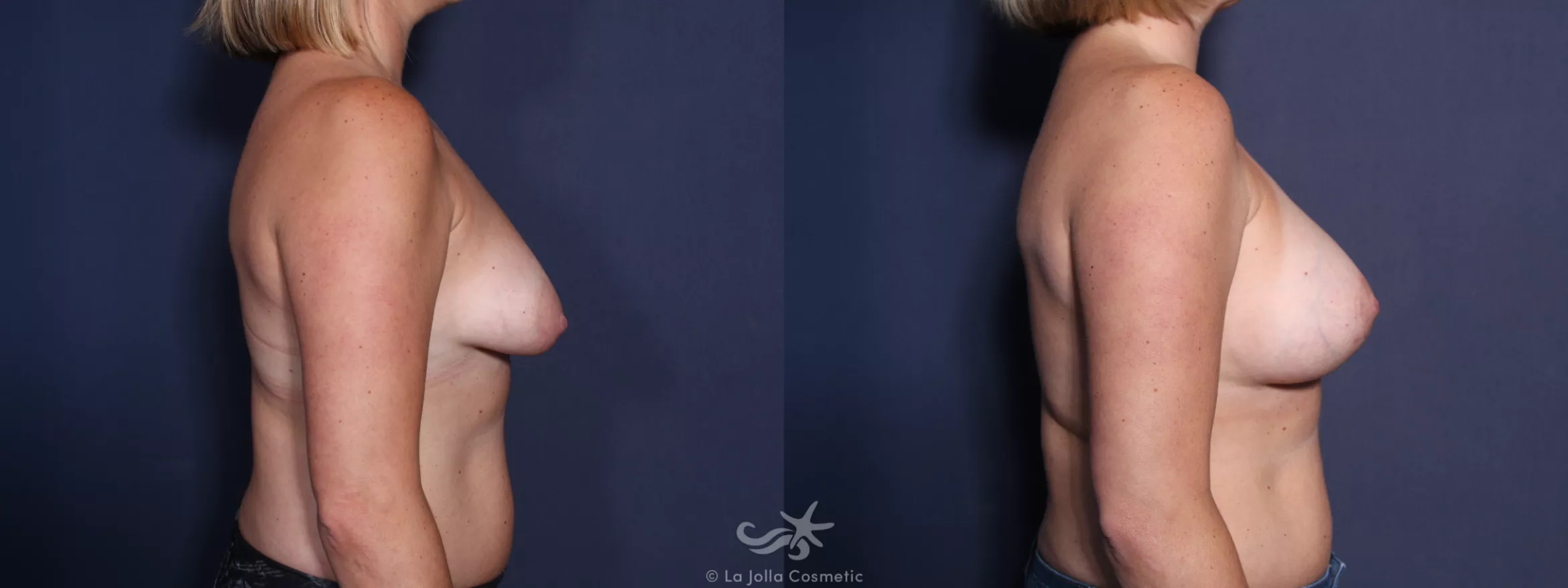 Before & After Breast Augmentation with Lift Result 39 Right Side View in San Diego, CA