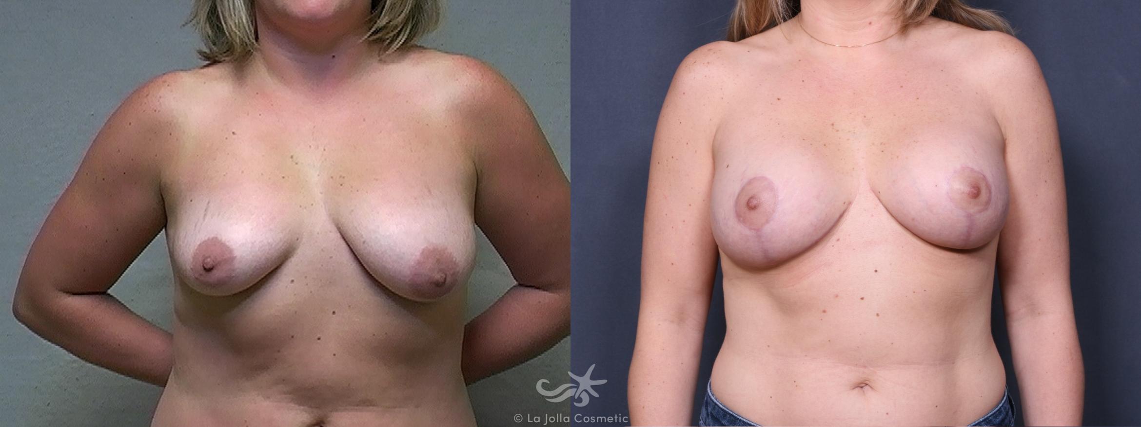 Before & After Breast Augmentation with Lift Result 411 Front View in San Diego, CA