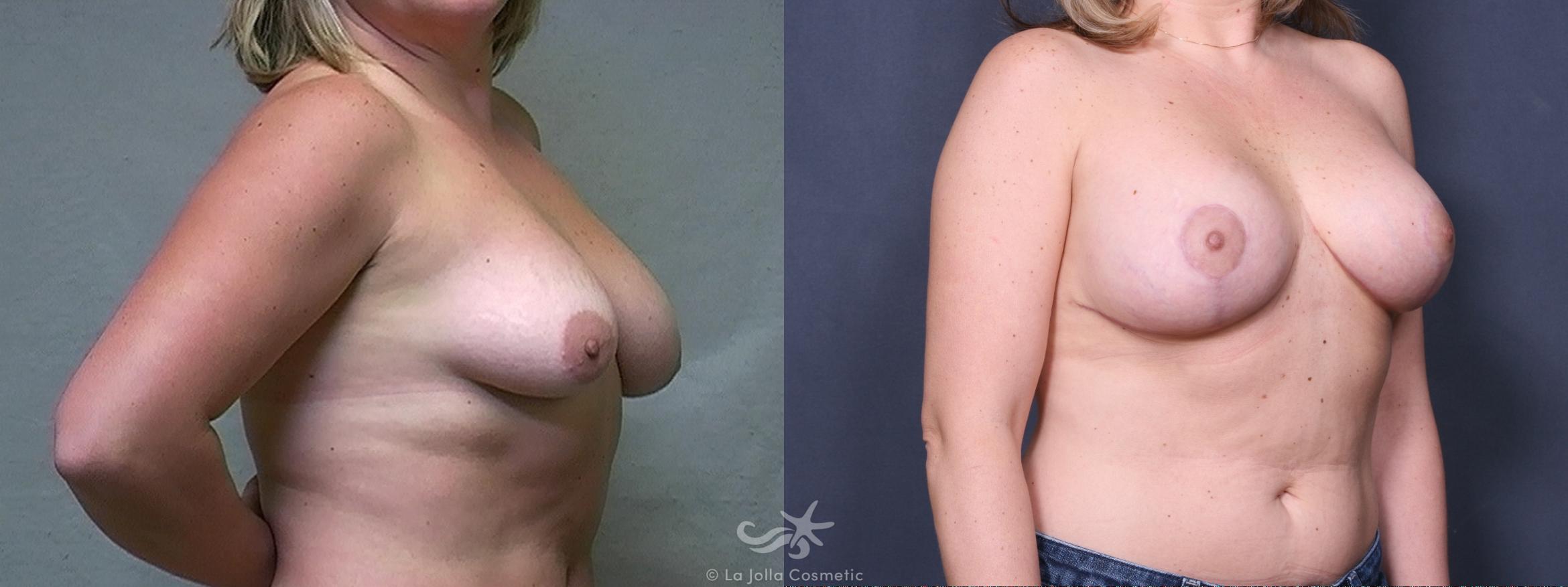Before & After Breast Augmentation with Lift Result 411 Right Oblique View in San Diego, CA