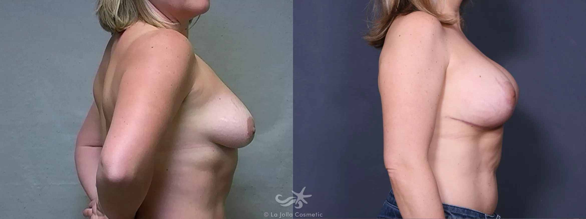 Before & After Breast Augmentation with Lift Result 411 Right Side View in San Diego, CA