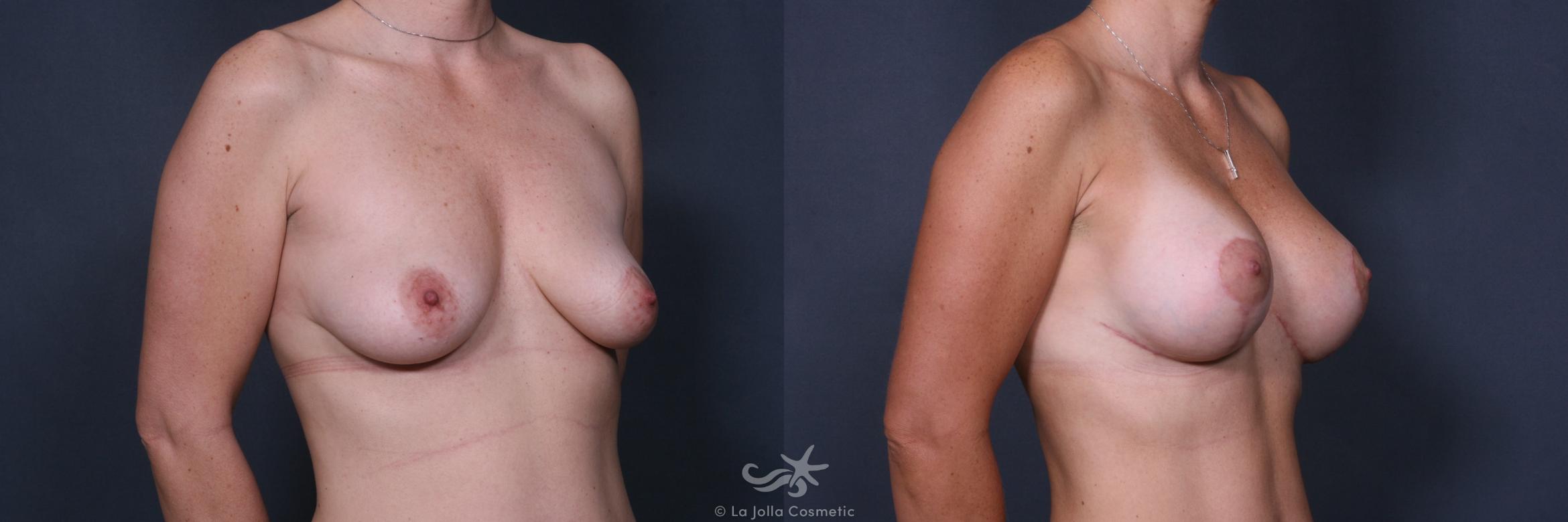 Before & After Breast Augmentation with Lift Result 423 Right Oblique View in San Diego, CA