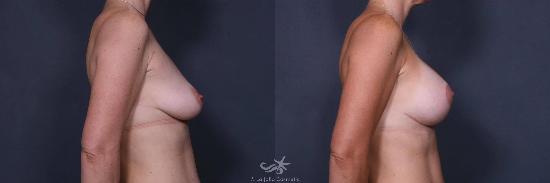 Before & After Breast Augmentation with Lift Result 423 Right Side View in San Diego, CA