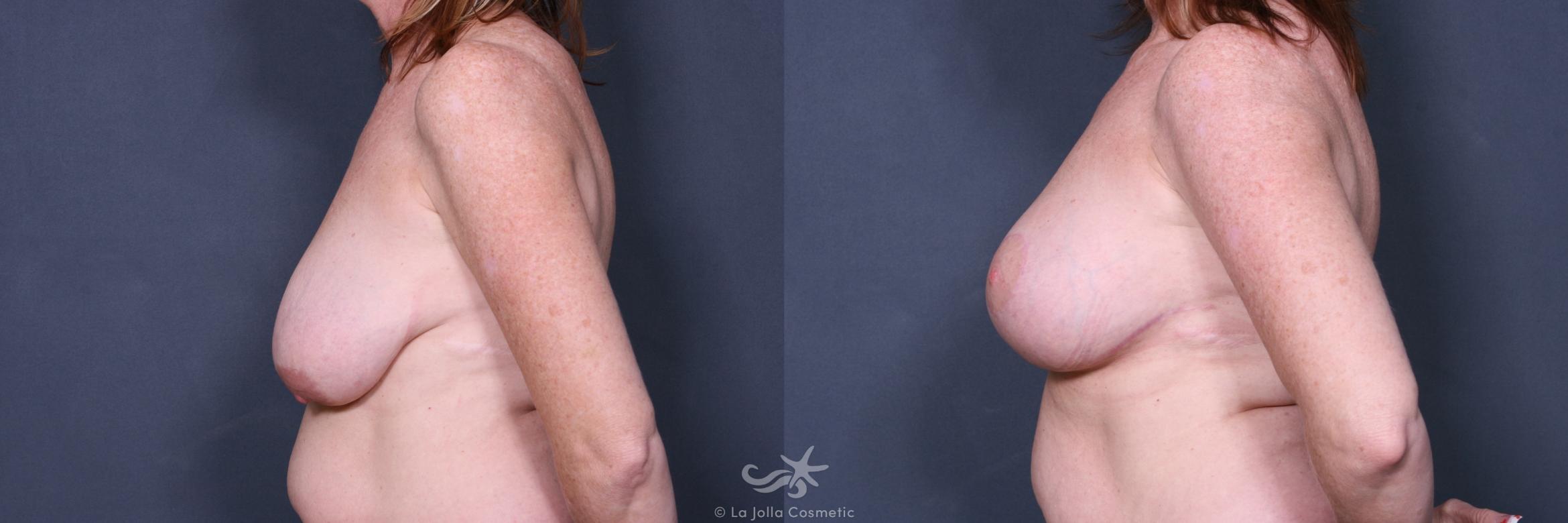 Before & After Breast Augmentation with Lift Result 450 Left Side View in San Diego, CA