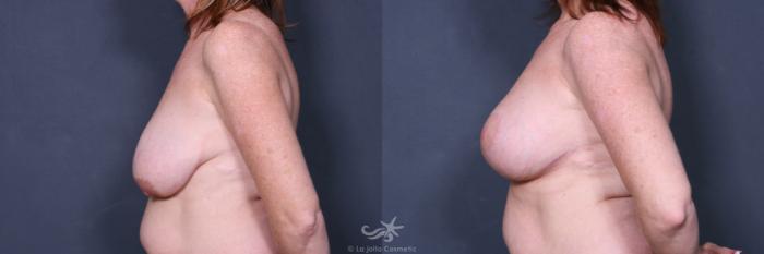 Before & After Breast Augmentation with Lift Result 450 Left Side View in San Diego, Carlsbad, CA