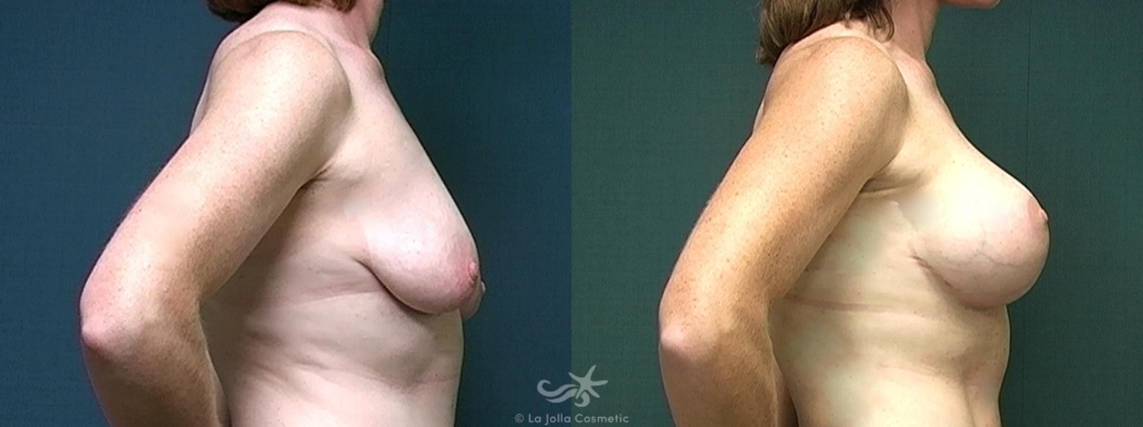 Before & After Breast Augmentation with Lift Result 471 Right Side View in San Diego, CA