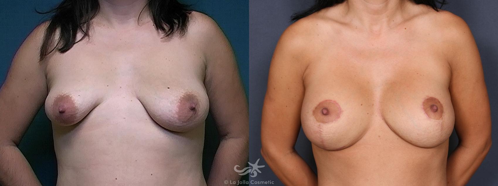 Before & After Breast Augmentation with Lift Result 485 Front View in San Diego, CA