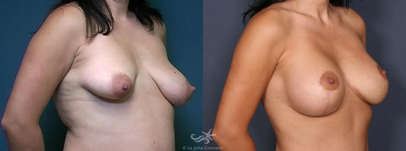 Before & After Breast Augmentation with Lift Result 485 Right Oblique View in San Diego, CA