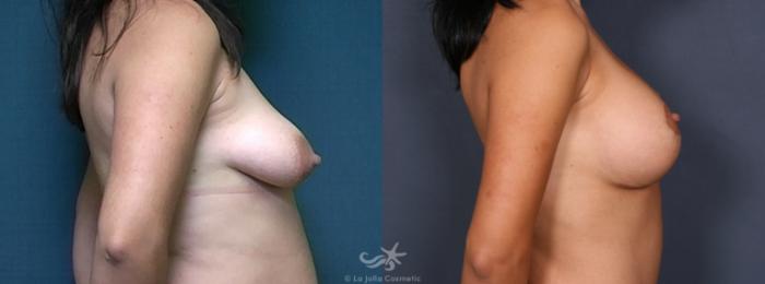 Before & After Breast Augmentation with Lift Result 485 Right Side View in San Diego, Carlsbad, CA