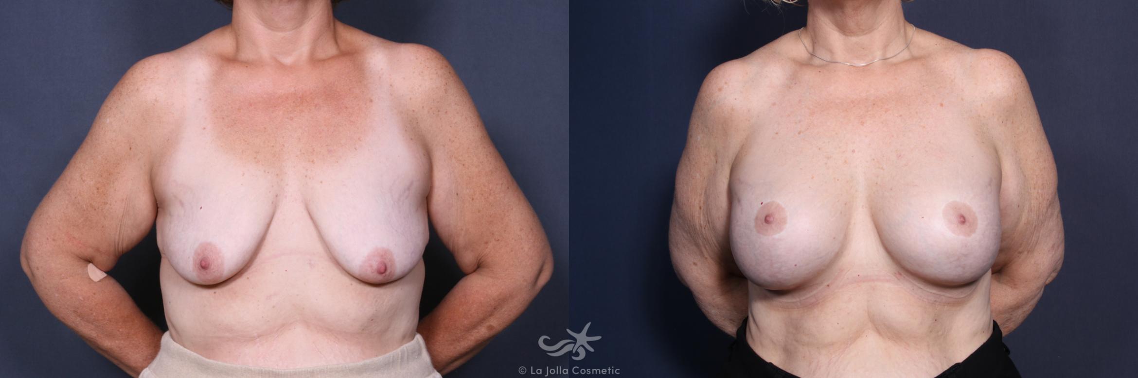 Before & After Breast Augmentation with Lift Result 518 Front View in San Diego, CA