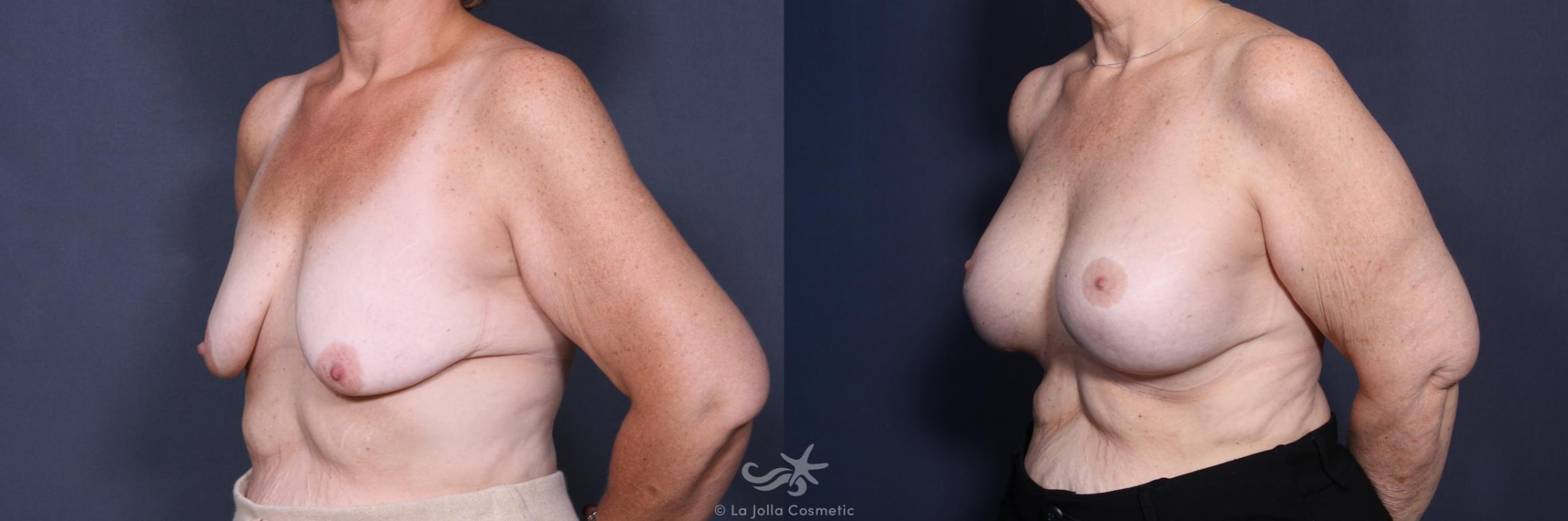 Before & After Breast Augmentation with Lift Result 518 Left Oblique View in San Diego, CA
