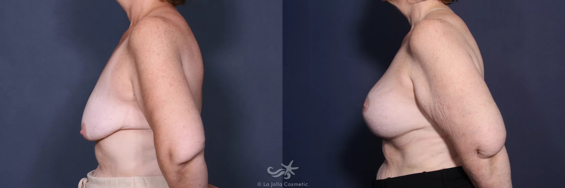 Before & After Breast Augmentation with Lift Result 518 Left Side View in San Diego, CA
