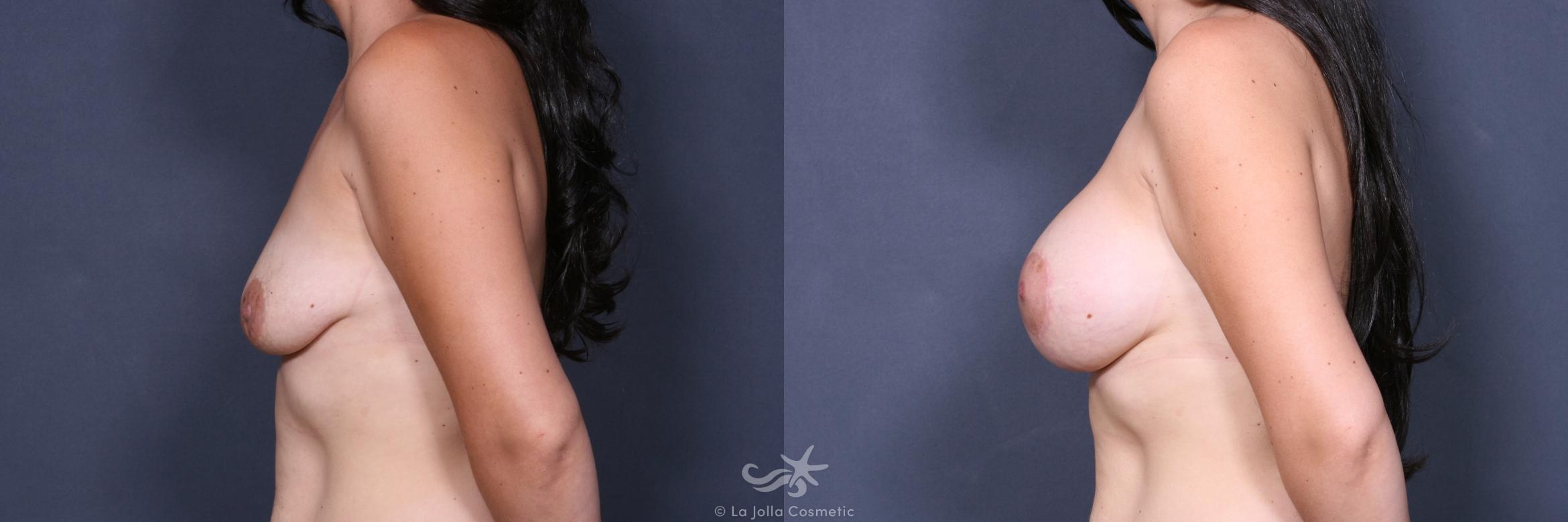 Before & After Breast Augmentation with Lift Result 522 Left Side View in San Diego, CA