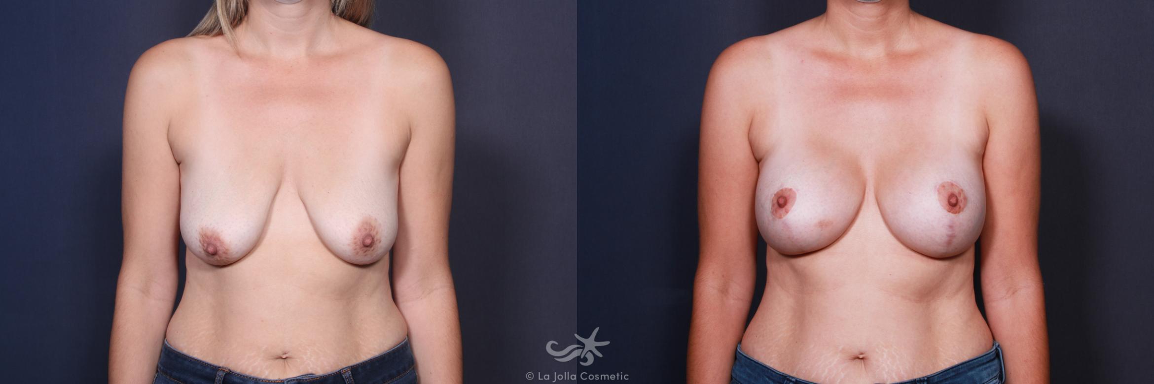 Before & After Breast Augmentation with Lift Result 553 Front View in San Diego, CA