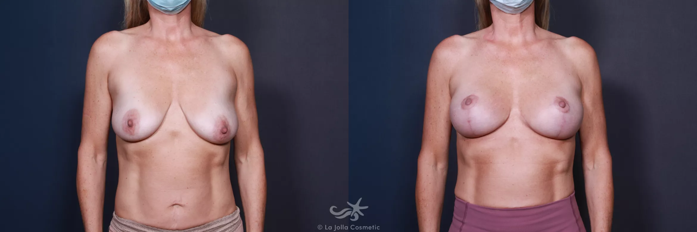 Before & After Breast Augmentation with Lift Result 559 Front View in San Diego, CA