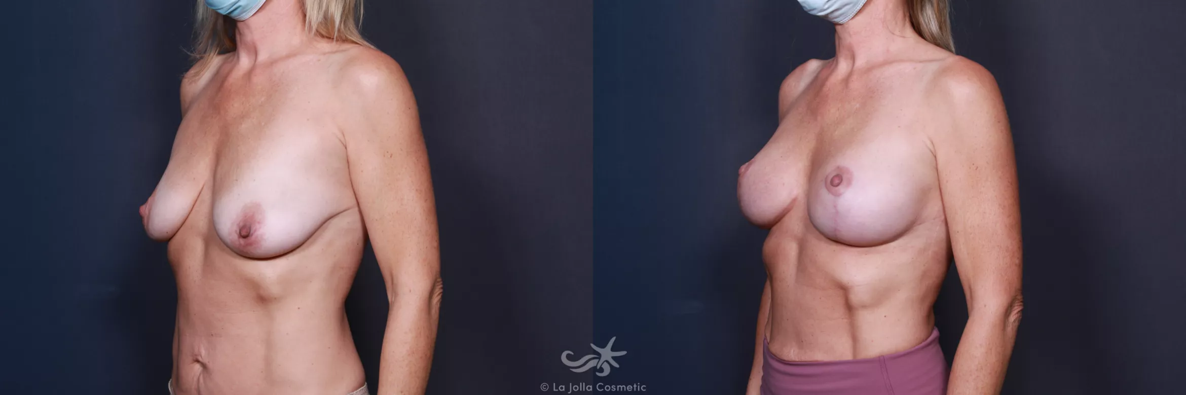 Before & After Breast Augmentation with Lift Result 559 Left Oblique View in San Diego, CA