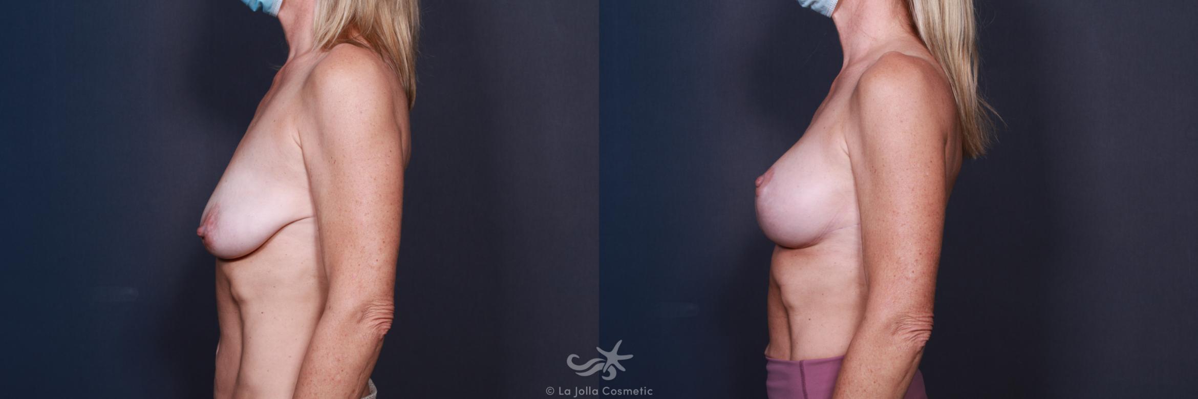 Before & After Breast Augmentation with Lift Result 559 Left Side View in San Diego, CA