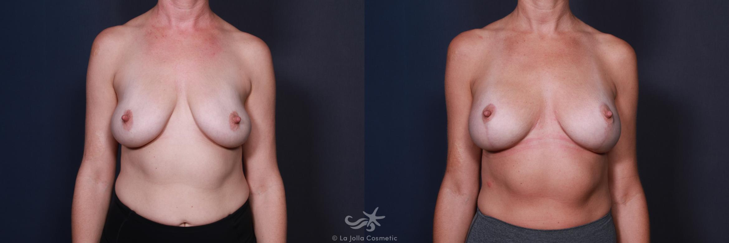 Before & After Breast Augmentation with Lift Result 567 Front View in San Diego, CA
