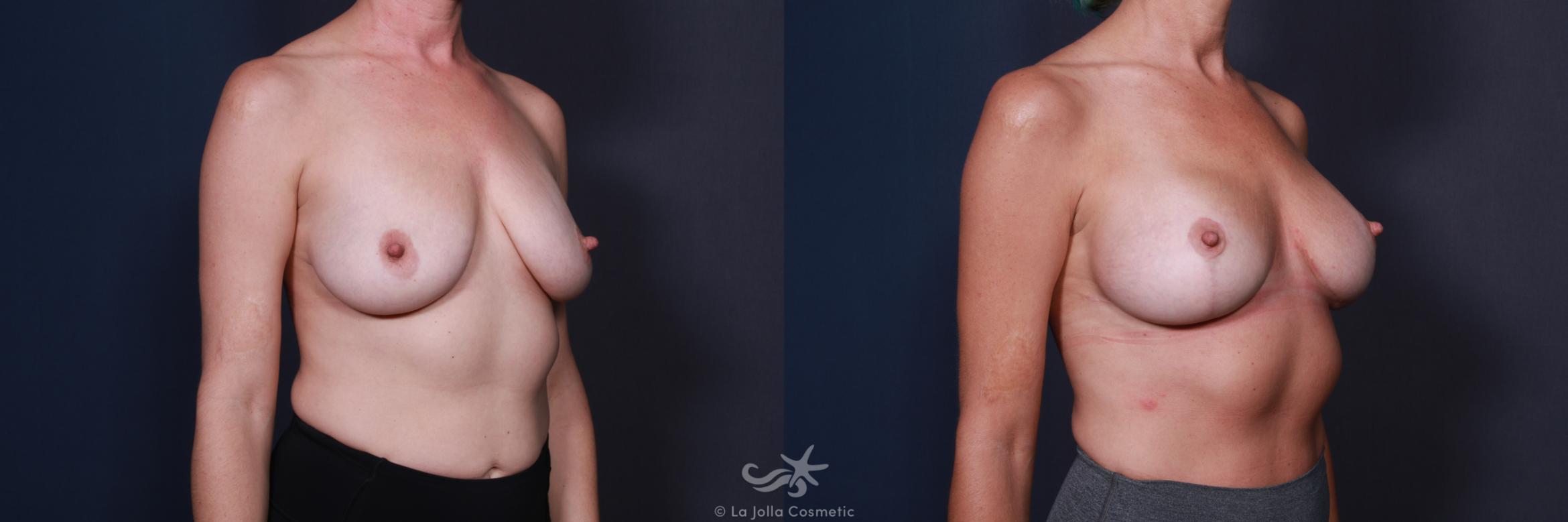 Before & After Breast Augmentation with Lift Result 567 Right Oblique View in San Diego, CA