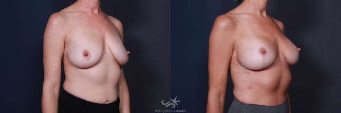 Before & After Breast Augmentation with Lift Result 567 Right Oblique View in San Diego, Carlsbad, CA