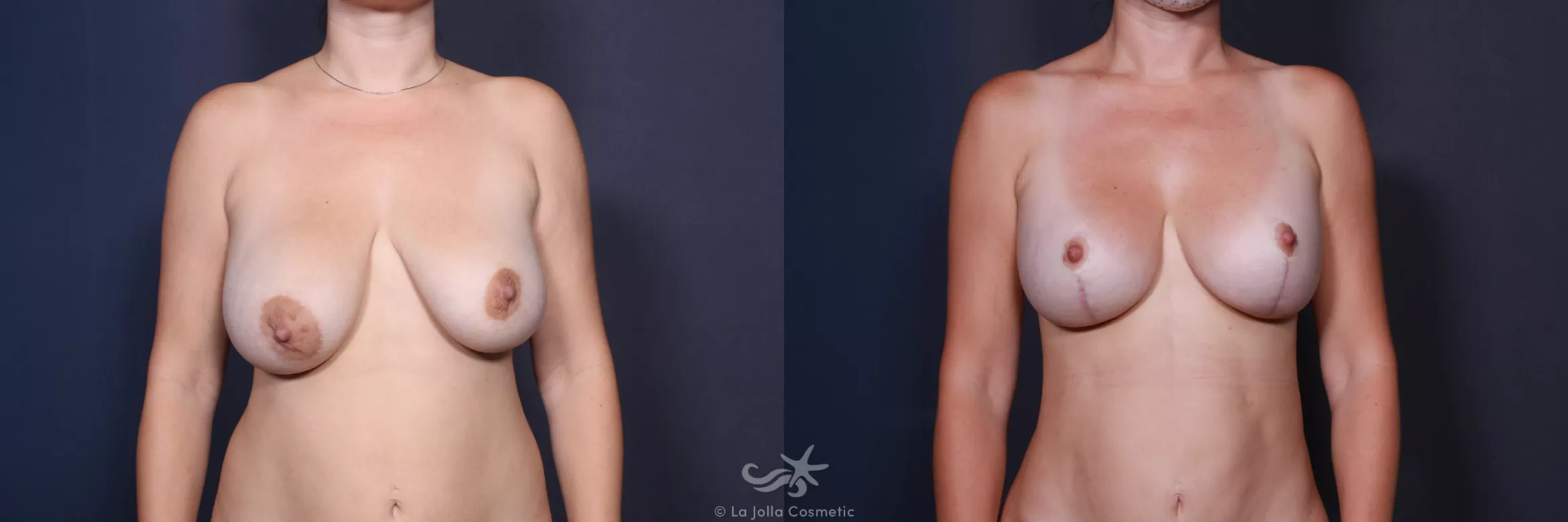 Before & After Breast Augmentation with Lift Result 569 Front View in San Diego, CA