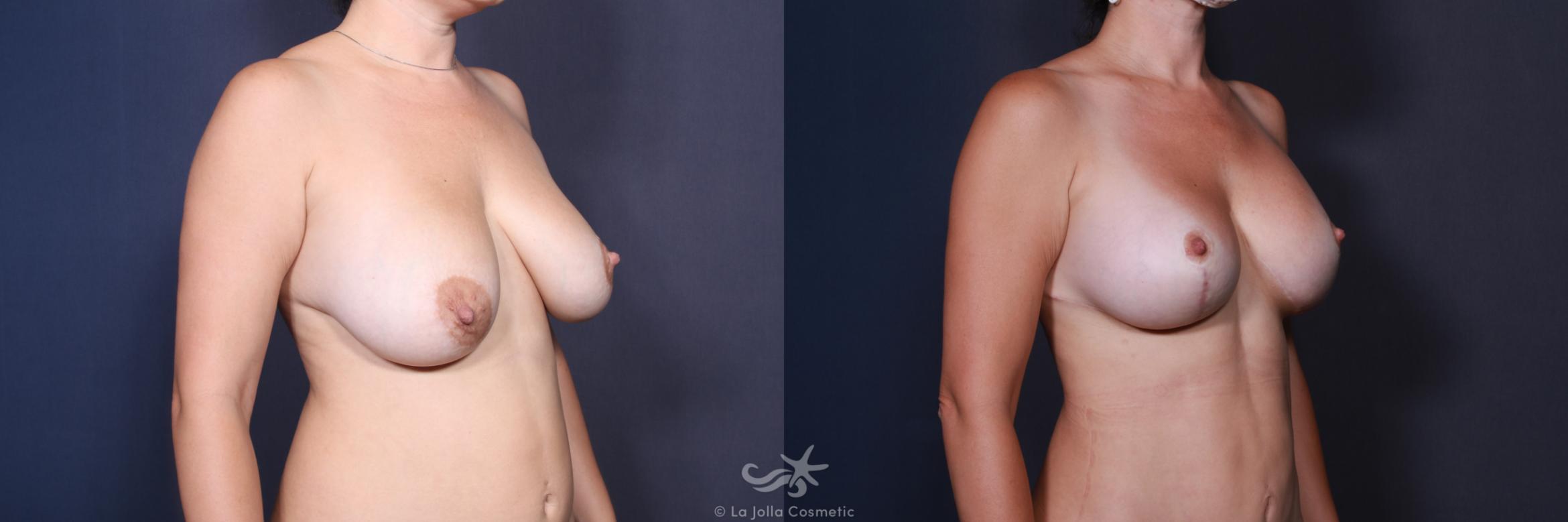 Before & After Breast Augmentation with Lift Result 569 Right Oblique View in San Diego, CA