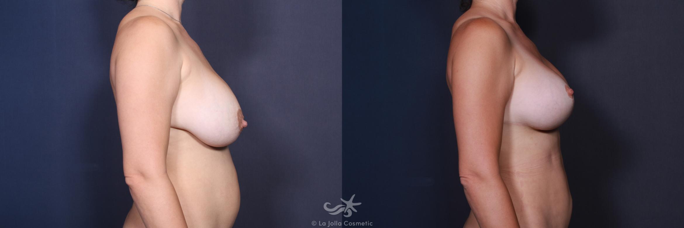 Before & After Breast Augmentation with Lift Result 569 Right Side View in San Diego, CA