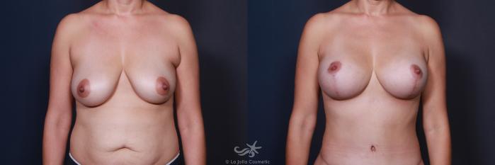 Before & After Breast Augmentation with Lift Result 572 Front View in San Diego, Carlsbad, CA