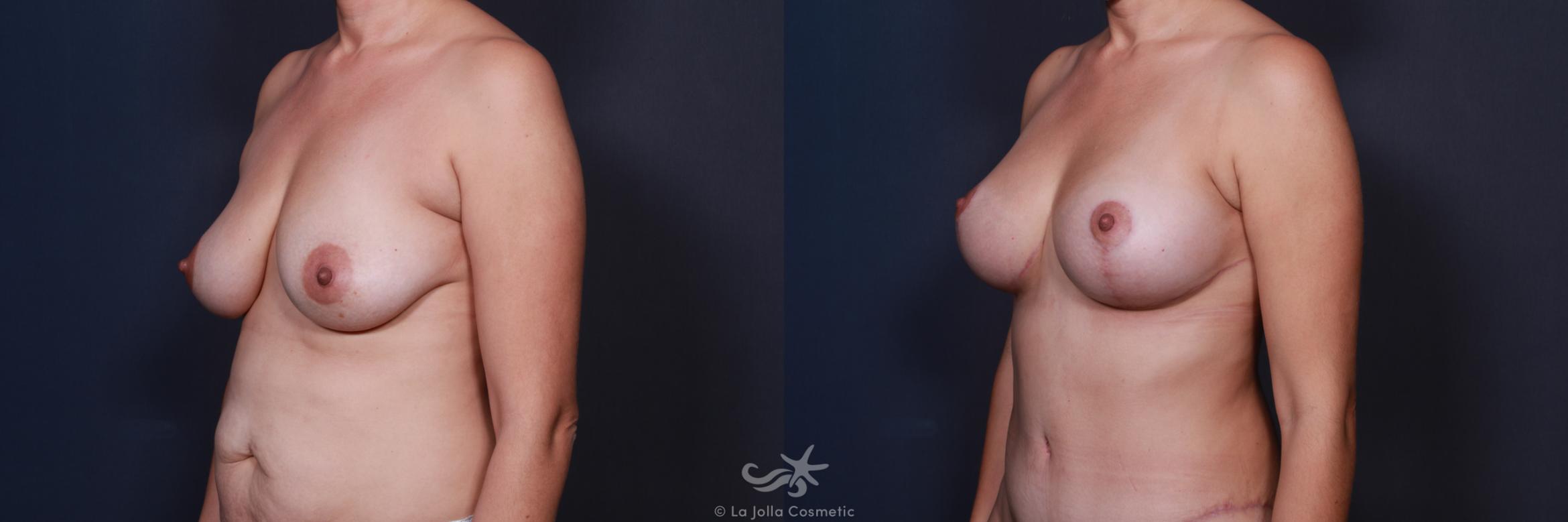 Before & After Breast Augmentation with Lift Result 572 Left Oblique View in San Diego, CA