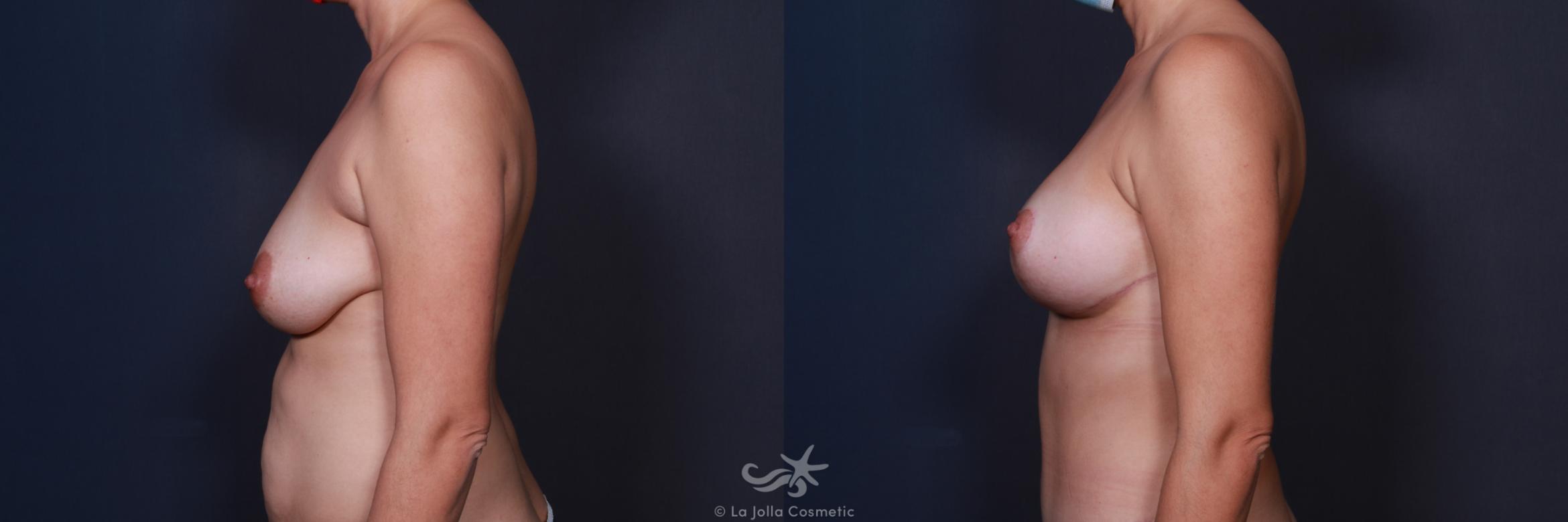 Before & After Breast Augmentation with Lift Result 572 Left Side View in San Diego, CA
