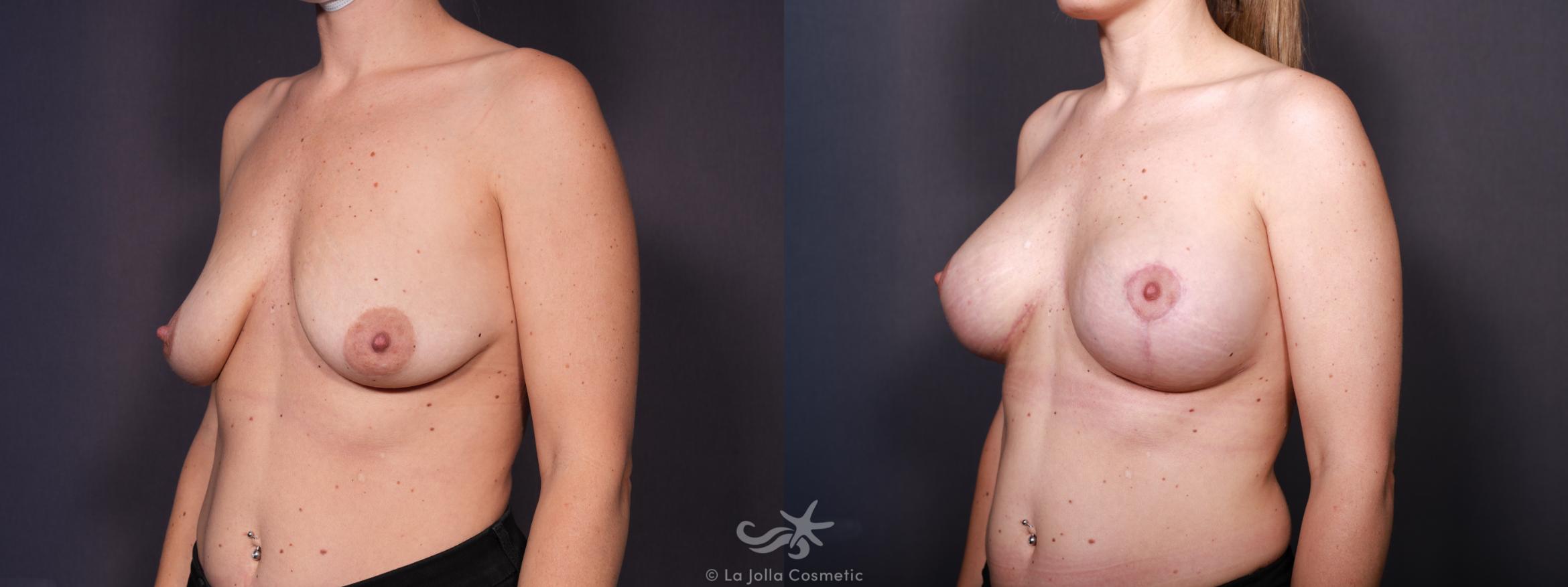 Before & After Breast Augmentation with Lift Result 617 Left Oblique View in San Diego, CA