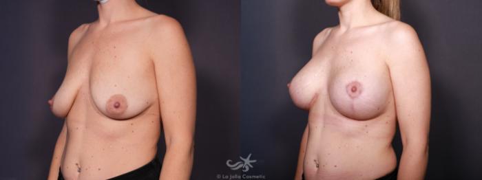 Before & After Breast Augmentation with Lift Result 617 Left Oblique View in San Diego, Carlsbad, CA