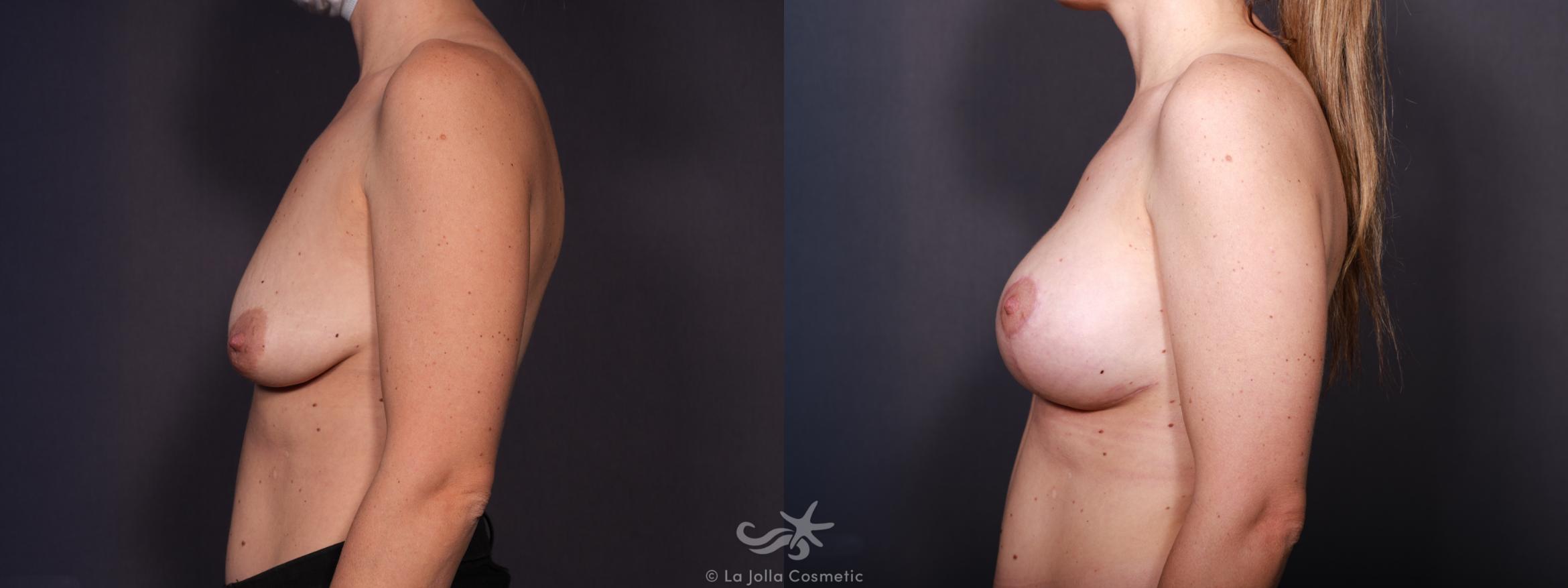 Before & After Breast Augmentation with Lift Result 617 Left Side View in San Diego, CA