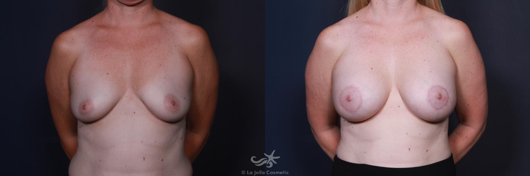 Before & After Breast Augmentation with Lift Result 63 Front View in San Diego, CA