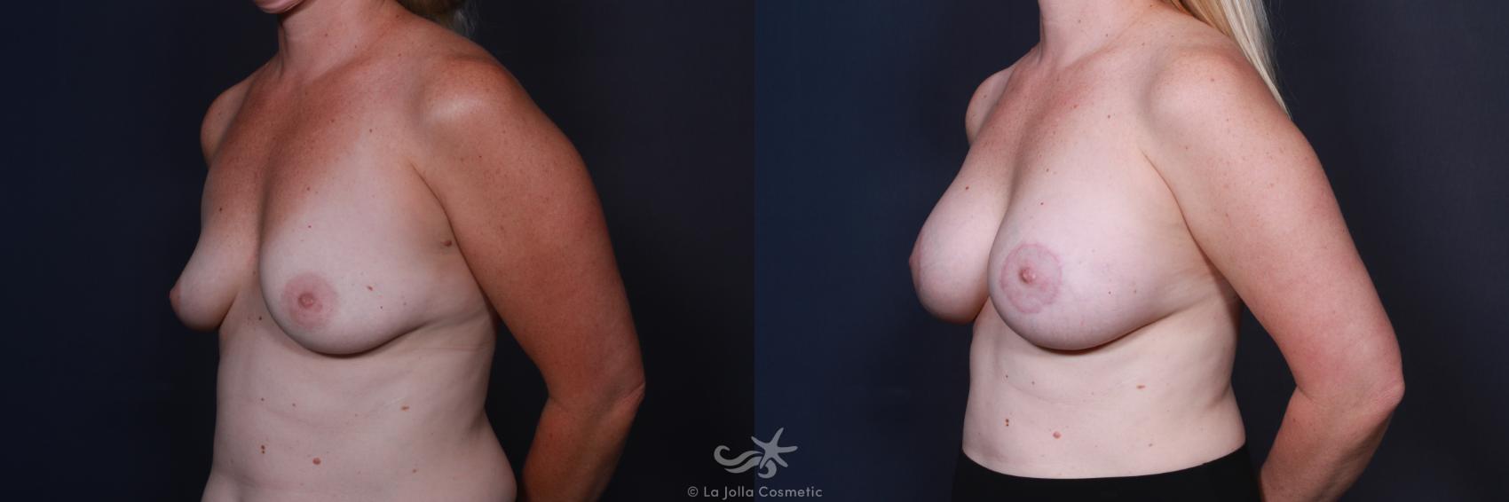 Before & After Breast Augmentation with Lift Result 63 Left Oblique View in San Diego, CA