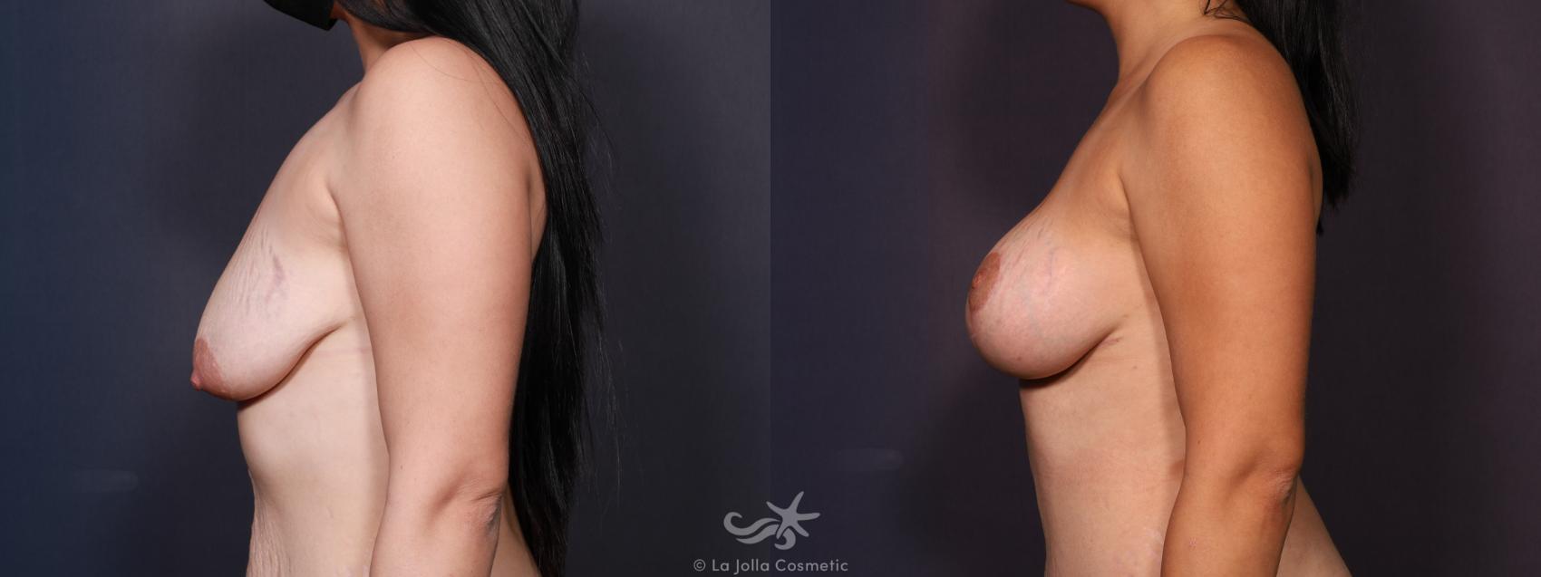 Before & After Breast Augmentation with Lift Result 643 Left Side View in San Diego, CA