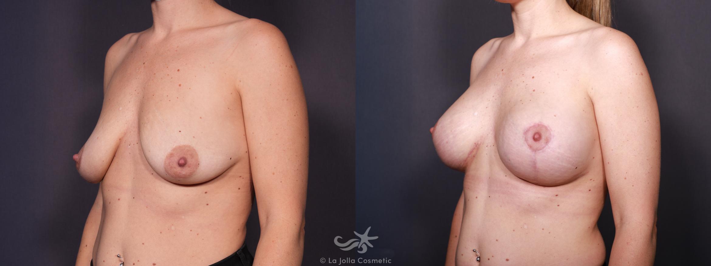 Before & After Breast Augmentation with Lift Result 644 Left Oblique View in San Diego, CA