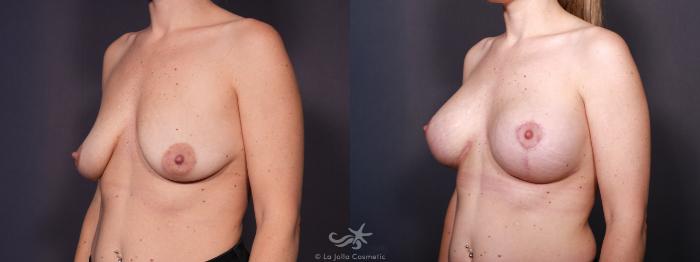 Before & After Breast Augmentation with Lift Result 644 Left Oblique View in San Diego, Carlsbad, CA