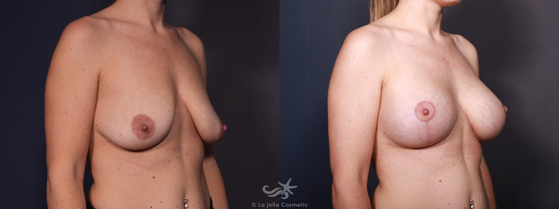 Before & After Breast Augmentation Result 644 Right Oblique View in San Diego, CA