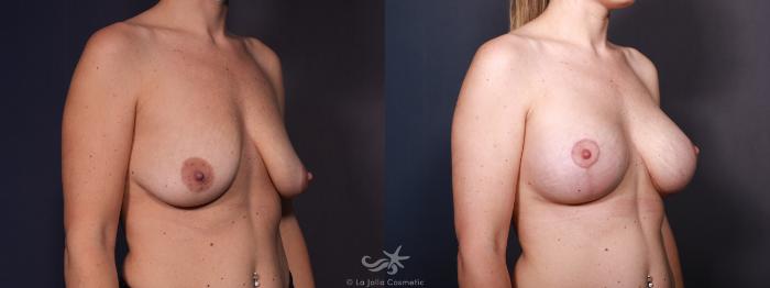 Before & After Breast Augmentation with Lift Result 644 Right Oblique View in San Diego, Carlsbad, CA
